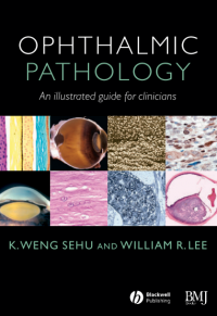 Ophthalmic Pathology An illustrated guide for clinicians